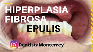 EPULIS HIPERPLASIA Fibrosa👅Causada por Prótesis Dentales