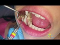 Molar Cavity Filling with Composite