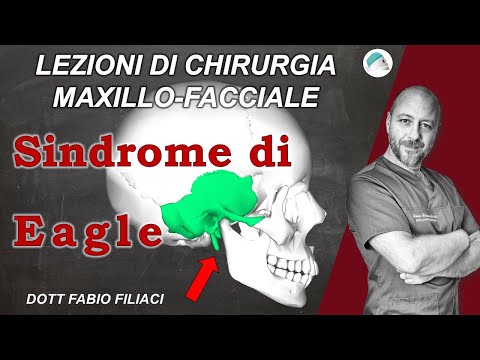 Video: Sindrome Di Eagle: Cause, Sintomi, Diagnosi, Trattamento E Altro