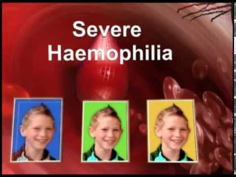 Механизъм на кръвосъсирване при хемофилия