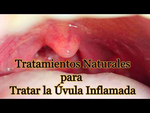 Vídeo: 3 maneres de reduir la inflamació de l'úvula