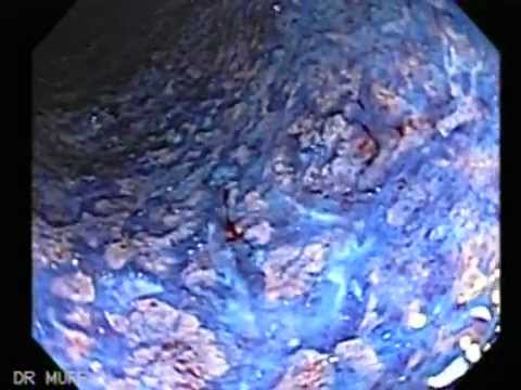 Colonoscopy of Ulcerative Colitis