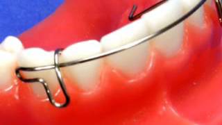Witzig Labial Bow Description