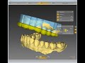 inLab 16 - 3D Printed Splint/Night Guard