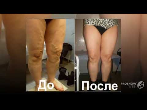 повышение тонуса сосудов снятие варикоза