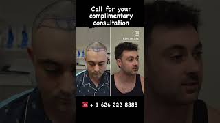 6 months Before and After post #fuehairtransplant @ 50% growth #fue #hair #fuehairrestoration