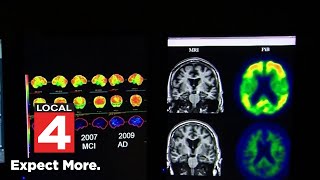 New blood test could detect Alzheimer's earlier