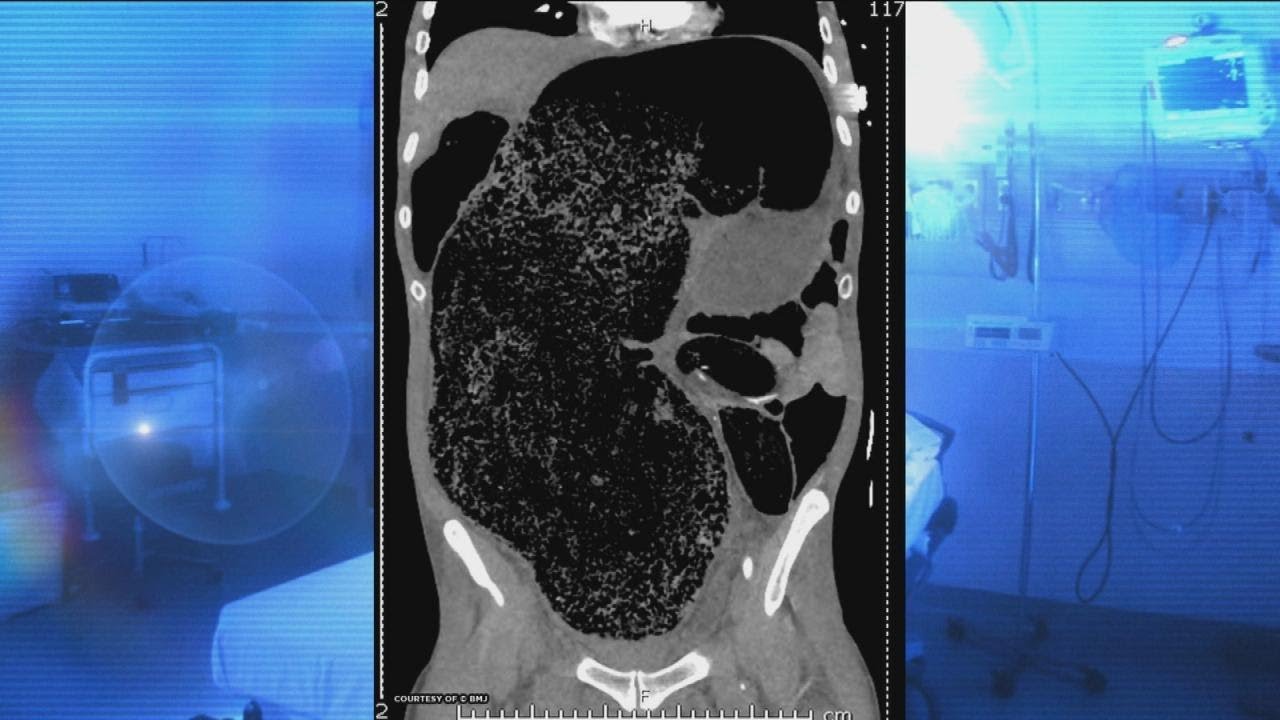 How Do You Know When Faecal Impaction Has Cleared?