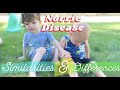 Spectrum of norrie disease similarities and difference between two blind toddlers with same disease