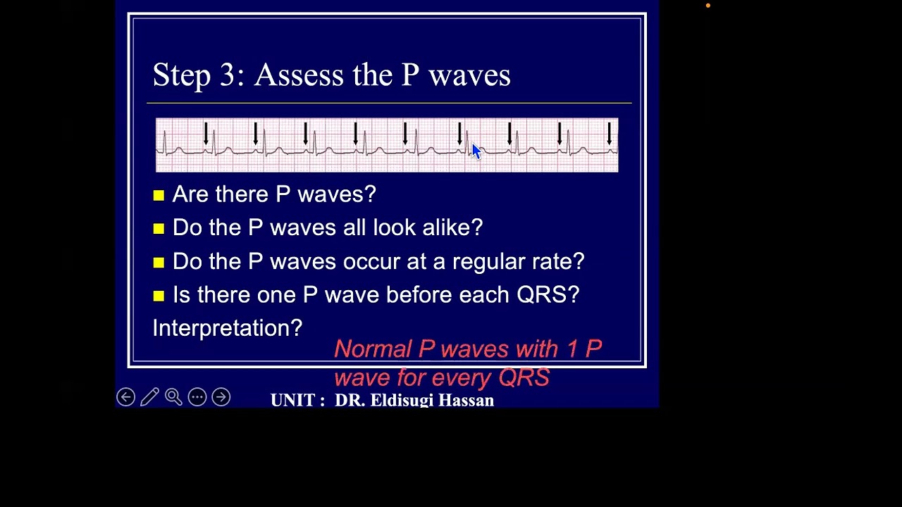ECG for the frontline clinicians-lecture 2