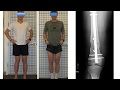 Dr. Rozbruch Discusses Knock-Knee Treatment