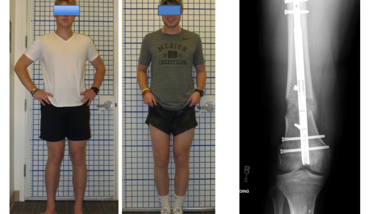 Dr. Rozbruch Discusses KnockKnee Treatment YouTube