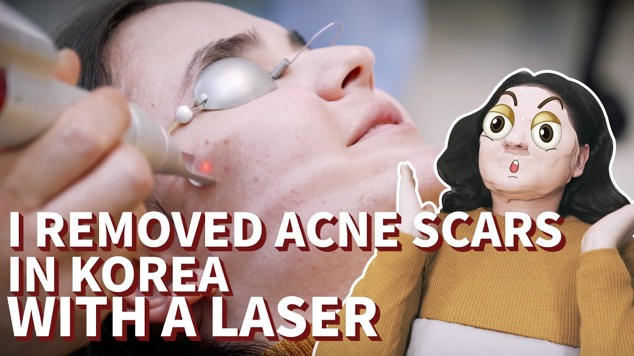 [Medilog] I removed acne scars in Korea with a laser YouTube