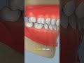 How Bimaxillary Osteotomy Surgery Is Done (3D Animation) #maxillofacial#medical3d #3danimation