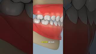 How Bimaxillary Osteotomy Surgery Is Done (3D Animation) #maxillofacial#medical3d #3danimation