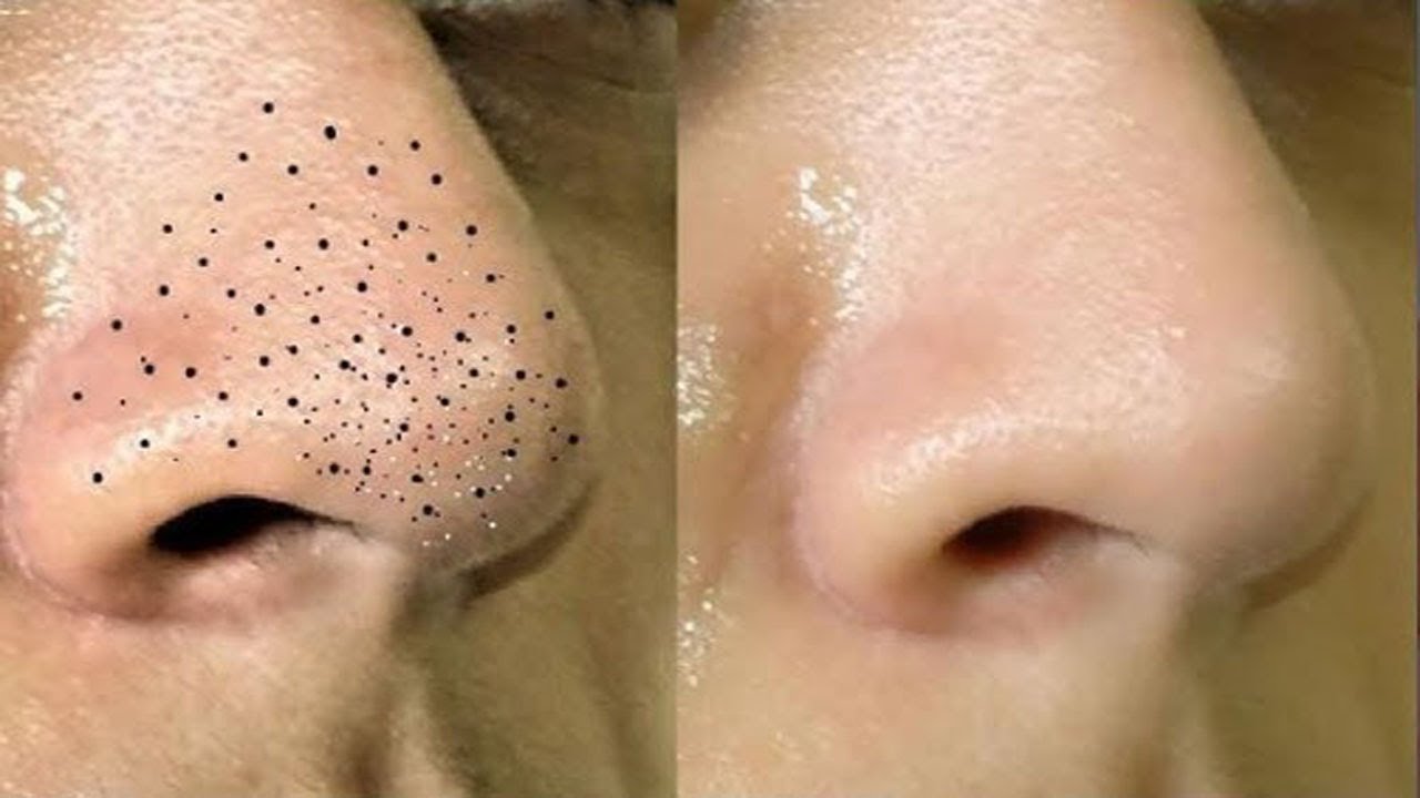 how to remove blackheads and whiteheads from nose and face naturally at ...