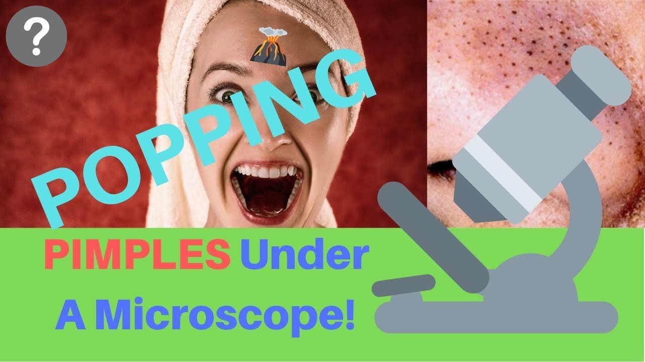 POPPING Bed Of BLACKHEADS Under A Microscope! YouTube
