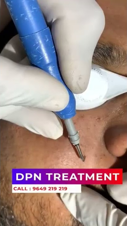 At Last, The Secret To DPN TREATMENT Is Revealed | Viral #shorts