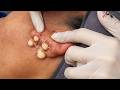 Feel The Extraction Through The Screen | Pimple Popping #800164