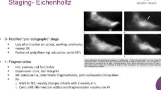 Charcot Arthropathy of Foot and Ankle By Dr Daniel Sydenham