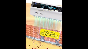 How to Use UV Phototherapy at Home for Skin Conditions like Vitiligo & Psoriasis
