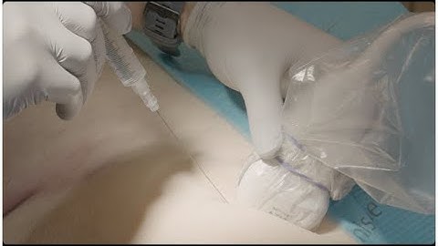 How to perform an ultrasound guided fascia iliaca nerve block