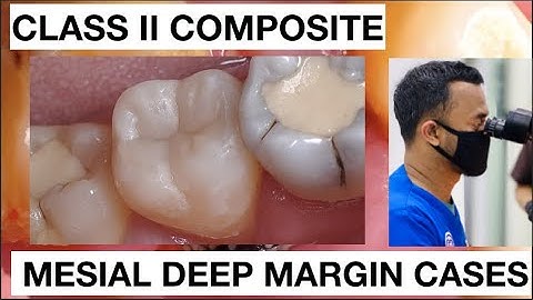 Step by step Class II Deep Margin Mesial Composite | General Dentist Griya RR