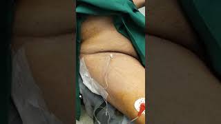 PNS guided Femoral nerve block