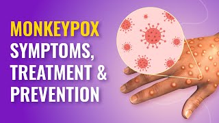 Monkeypox Symptoms, Causes And Treatment Monkeypox In Humans Mfine