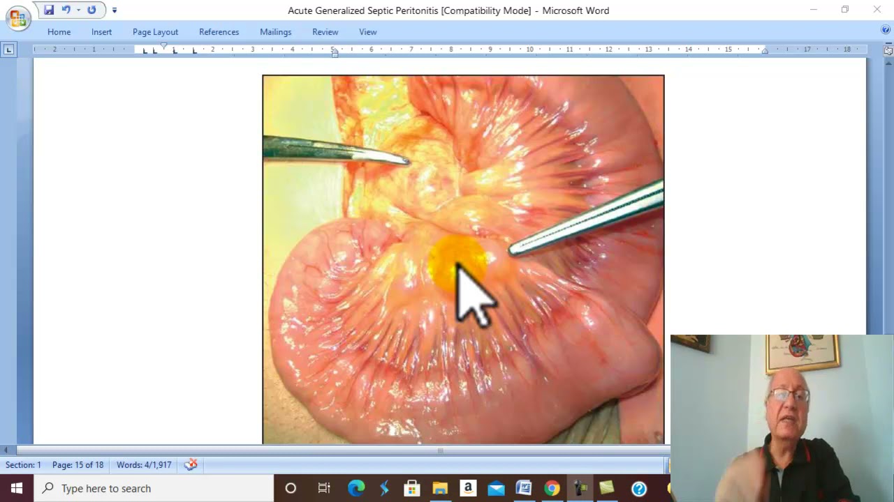 Peritoneal Disorders In Arabic 4 Acute Non Specific Mesenteric Peritoneal Disorders In Arabic 4 Acute Non Specific Mesenteric
