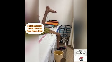 Rotationplasty Reversed Ankle Joint working as New Knee Joint