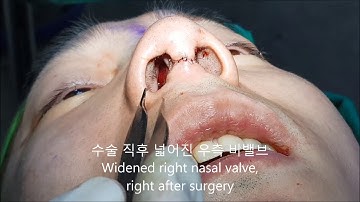 비밸브 교정술 (Nasal valve surgery)