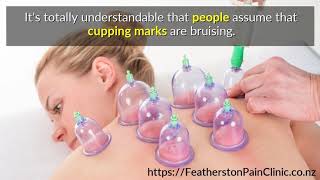 3 Cupping Myths Debunked Profile