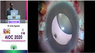 AIOC2020 IC382 T5 Dr Amar Agarwal IOL SCAFFOLD AFTER PCR screenshot 4