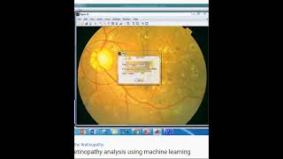 Diabetic retinopathy analysis using machine learning DREAM -MATLAB RESEARCH PROJECT screenshot 2