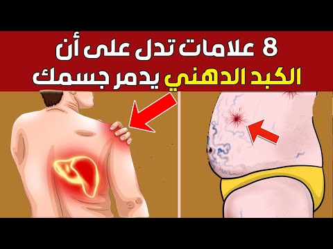 8 علامات تدل على أنك تعاني من الكبد الدهني إكتشفها الآن لإنقاذ حياتك