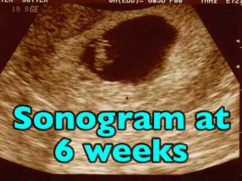 First Trimester Sonograms (Pregnancy Health Guru) - YouTube