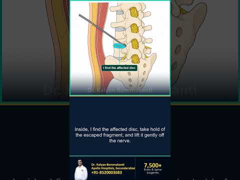 Monoportal or Biportal: Which Keyhole? - Best Monoportal Endoscopic Spine Surgeon, Hyderabad