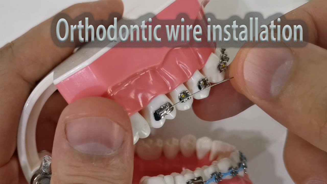 How to install & ligate orthodontic wire with elastic ligature and ss