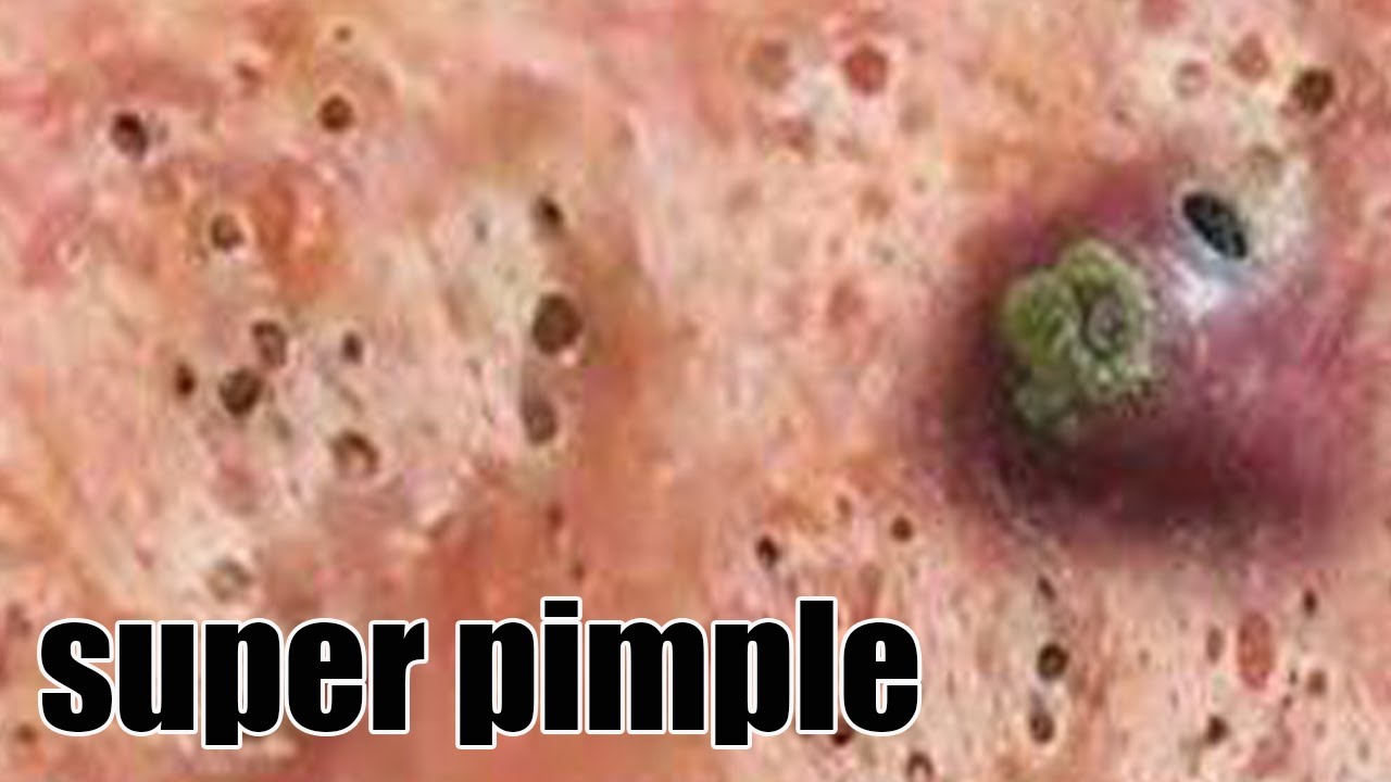 Relax Every Day With NaSa Spa TV Top blackhead remover 2021 video8