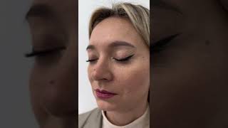 Ce Părere Ai Despre Acest Rezultat? 1 An De La Operația De Blefaroplastie La Dr. Levy Medical Center