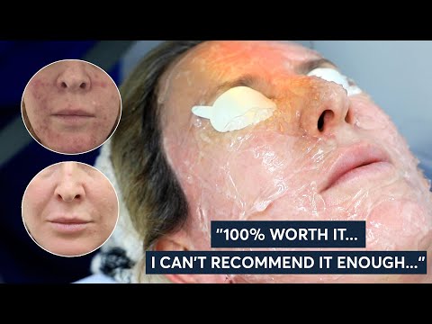 Treatment That Changed My Life - Rosacea Treatment | London