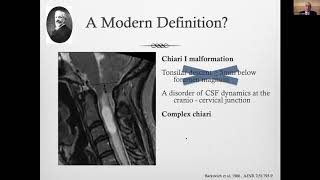 Chiari 1 malformation in adults: Diagnosis & management, principles & controversies, tips & pearls.