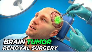 Brain Tumor Surgery 3D Animation Symptoms, Treatment, and Real Life Stories