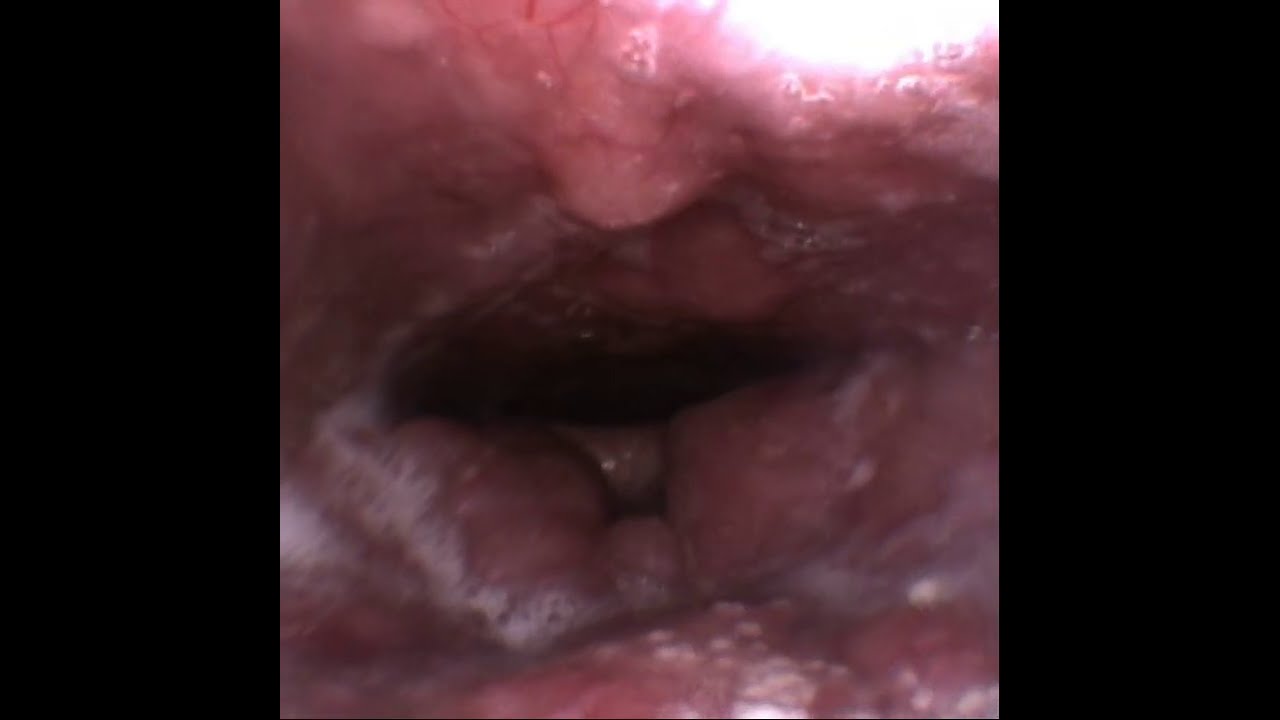 Lingual Tonsil Hypertrophy And Tonsillitis Youtube