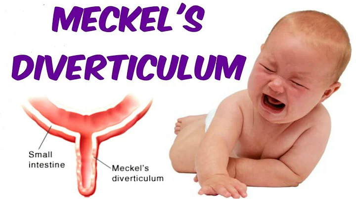 Meckel's Diverticulum