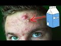 THAT'S A DAIRY PIMPLE | Derms Won't Tell You This