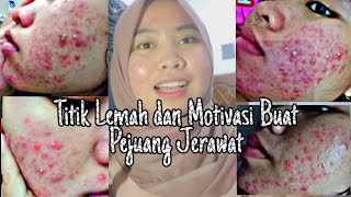 Titik Lemah dan Motivasi Buat Pejuang Jerawat!!- YOU ARE BEAUTIFUL ACNE FIGHTER!!! #Myacnestory