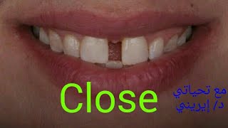 علاج فلجة الأسنان ( المسافة بين الأسنان الأمامية )د/إيريني Diastema treatment Dr. Ireny