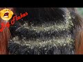 Scalp Psoriasis Scratching Black Hair (Dandruff Removal) # 874